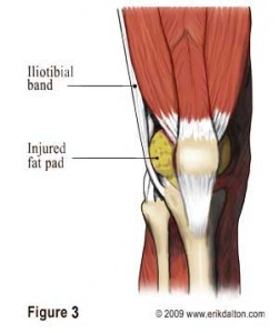STOP FOAM ROLLING YOUR ITB - Newsletters Knee Fats