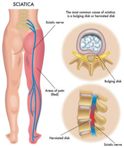 Back pain, Shoulder pain, Knee pain - Newsletters back pain