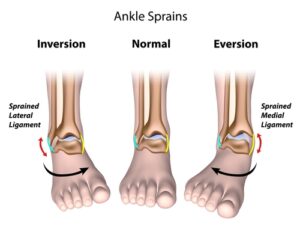 High Ankle Sprain. Syndesmosis Injury - Foot and Ankle Pain Ankle Sprains