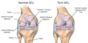 ACL Injury Prevention - Knee and Leg Pain ACL Injury