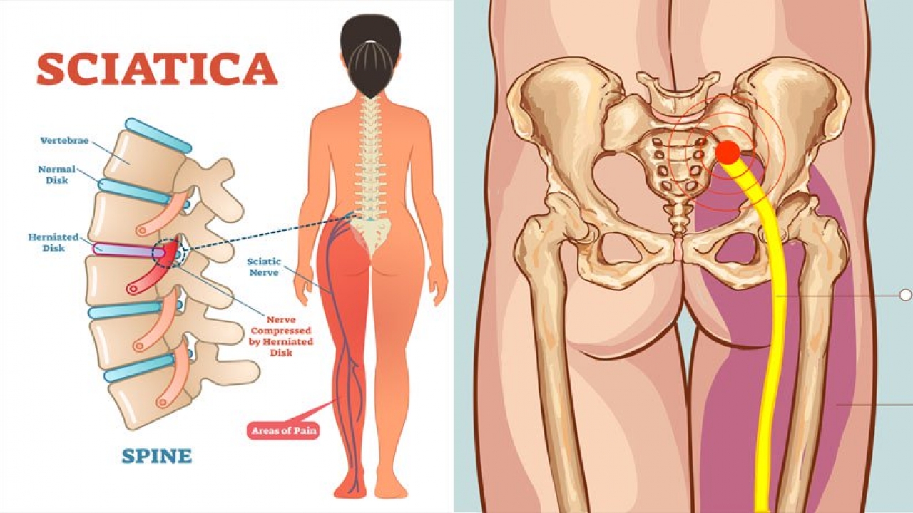 Sciatica A Pain In The Bum Literally Equilibrium Sports And Spinal Clinic