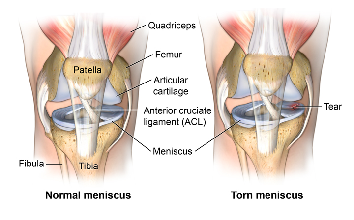 normal and torn meniscus Equilibrium Sports and Spinal Clinic