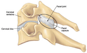 Neck Pain..Dont suffer any longer! - Neck Pain facet-joint