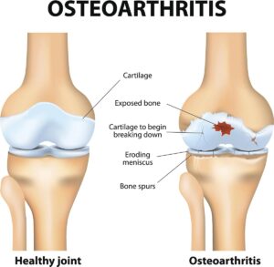 knee arthritis Ashburton Equilibrium Sports and Spinal Clinic