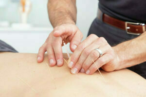 Dry Needling and Osteopathy - Dry Needling Dry needling 2