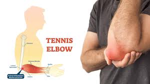 Tennis Elbow images