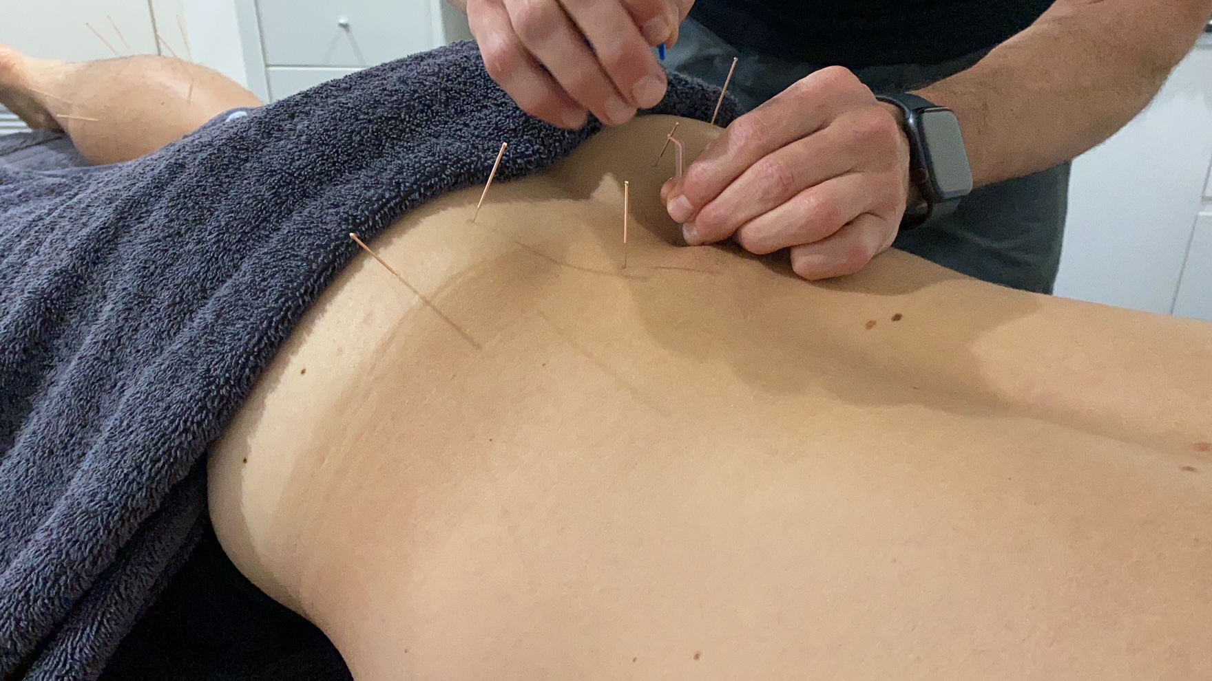 Dry Needling