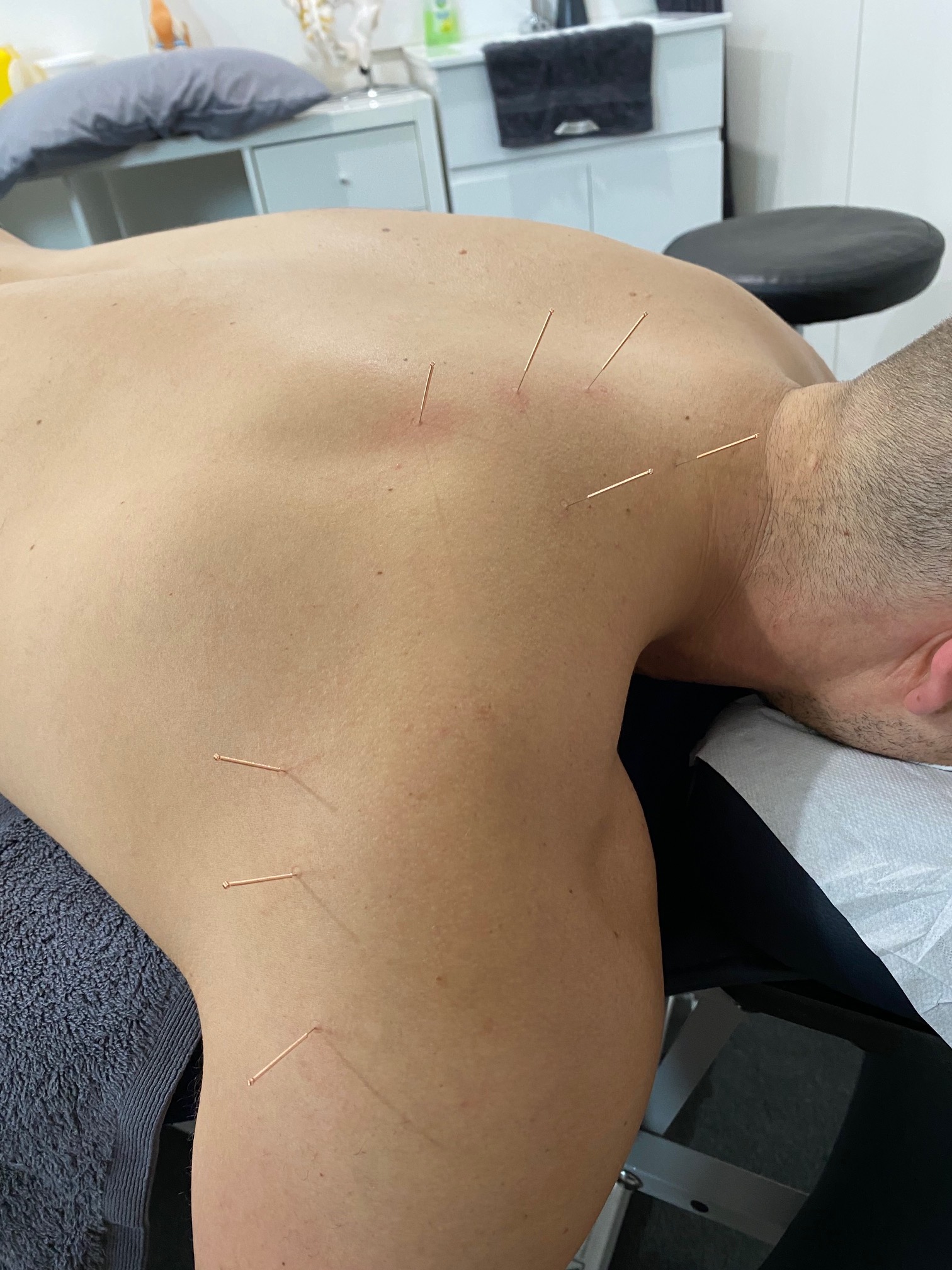 Dry Needling