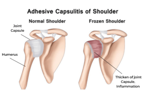 Frozen Shoulder Treatment - Osteopathy Frozen Shoulder