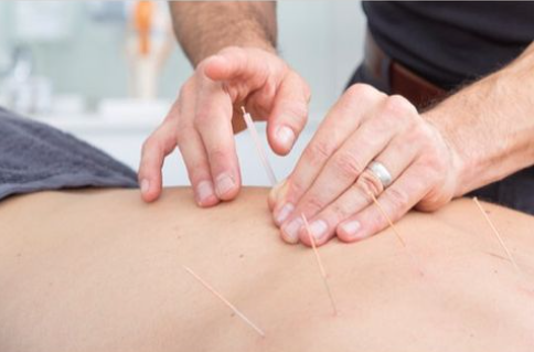 Dry Needling by Osteopaths In Glen Iris