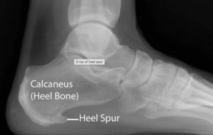 Plantar Fasciitis Treatment. Our Top 4 Key Elements - Foot and Ankle Pain Plantar Fasciitis