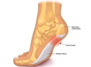 Plantar Fasciitis Treatment. Our Top 4 Key Elements - Foot and Ankle Pain Plantar Fasciitis