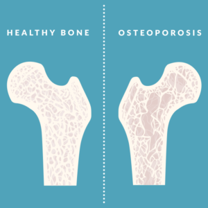 osteoporosis