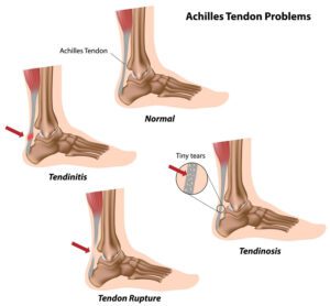 Our Top 5 Most Common Running Injuries! - Foot and Ankle Pain Common running injuries