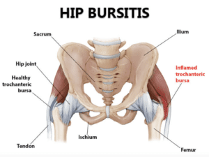 Debunking The Hip Bursitis Myth - Active Lifestyle & Gym Soreness Screen Shot 2023 10 25 at 5.03.52 pm Equilibrium Sports and Spinal Clinic