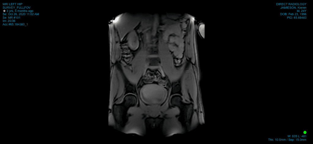 Hip Pain: How our 3rd Osteo, Kieren, Overcame a Devastating Career Ending Hip Pain Without Surgery - Hip Pain hip pain