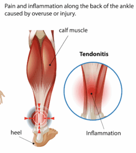 Tendinopathy Treatment